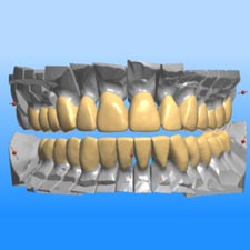 Implant Dentist Grand Rapids